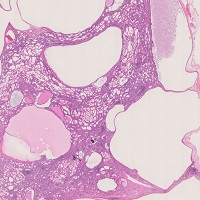 多発性嚢胞腎
